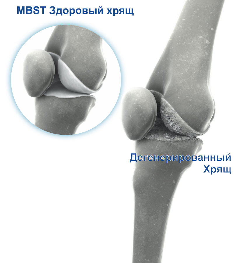 Артроз коленного сустава в медицинских центрах thumbnail