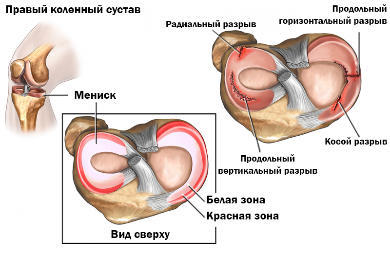 Лечение мениска коленного сустава в санатории